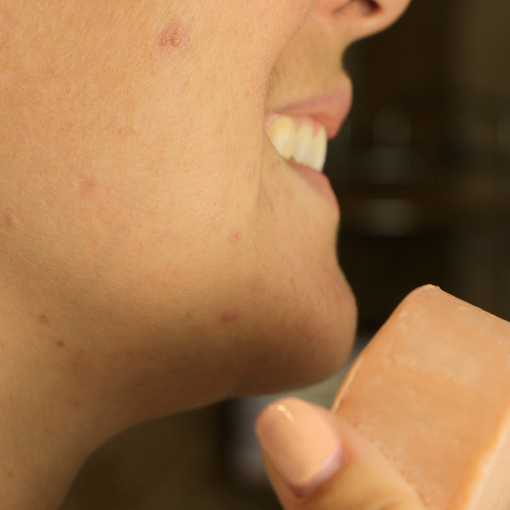 découvrez les causes et solutions pour les boutons après un soin du visage. apprenez à apaiser votre peau et à prévenir ces imperfections indésirables pour un teint éclatant et sain.
