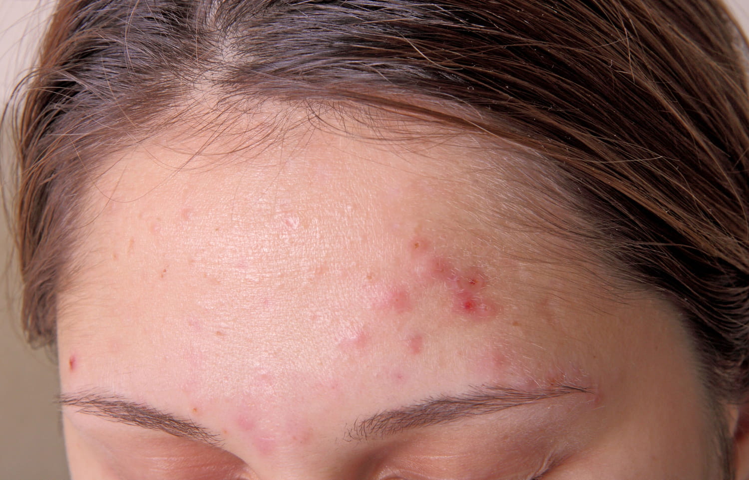 découvrez des conseils d'experts pour traiter efficacement les boutons d'acné. obtenez des recommandations de dermatologues pour améliorer votre peau et retrouver confiance en vous.
