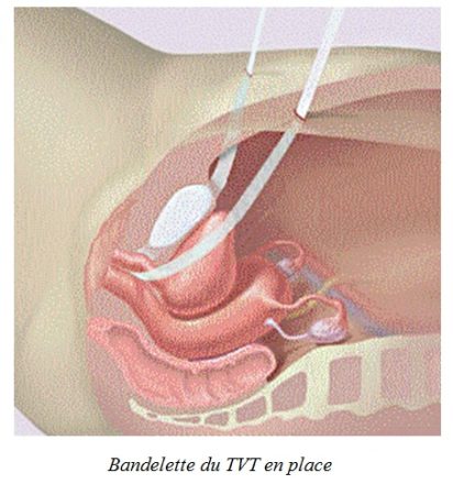 découvrez tout sur la bandelette amniotique, un élément essentiel de la grossesse. apprenez son rôle, son importance dans le développement fœtal et les implications pour la santé maternelle et infantile.