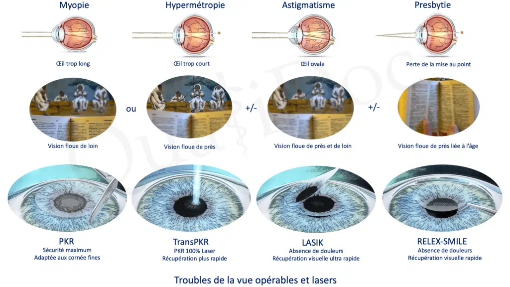 découvrez la chirurgie de la myopie à marseille, une solution innovante pour corriger votre vision et améliorer votre qualité de vie. consultez nos experts en ophtalmologie et retrouvez une vue claire et nette dès aujourd'hui.