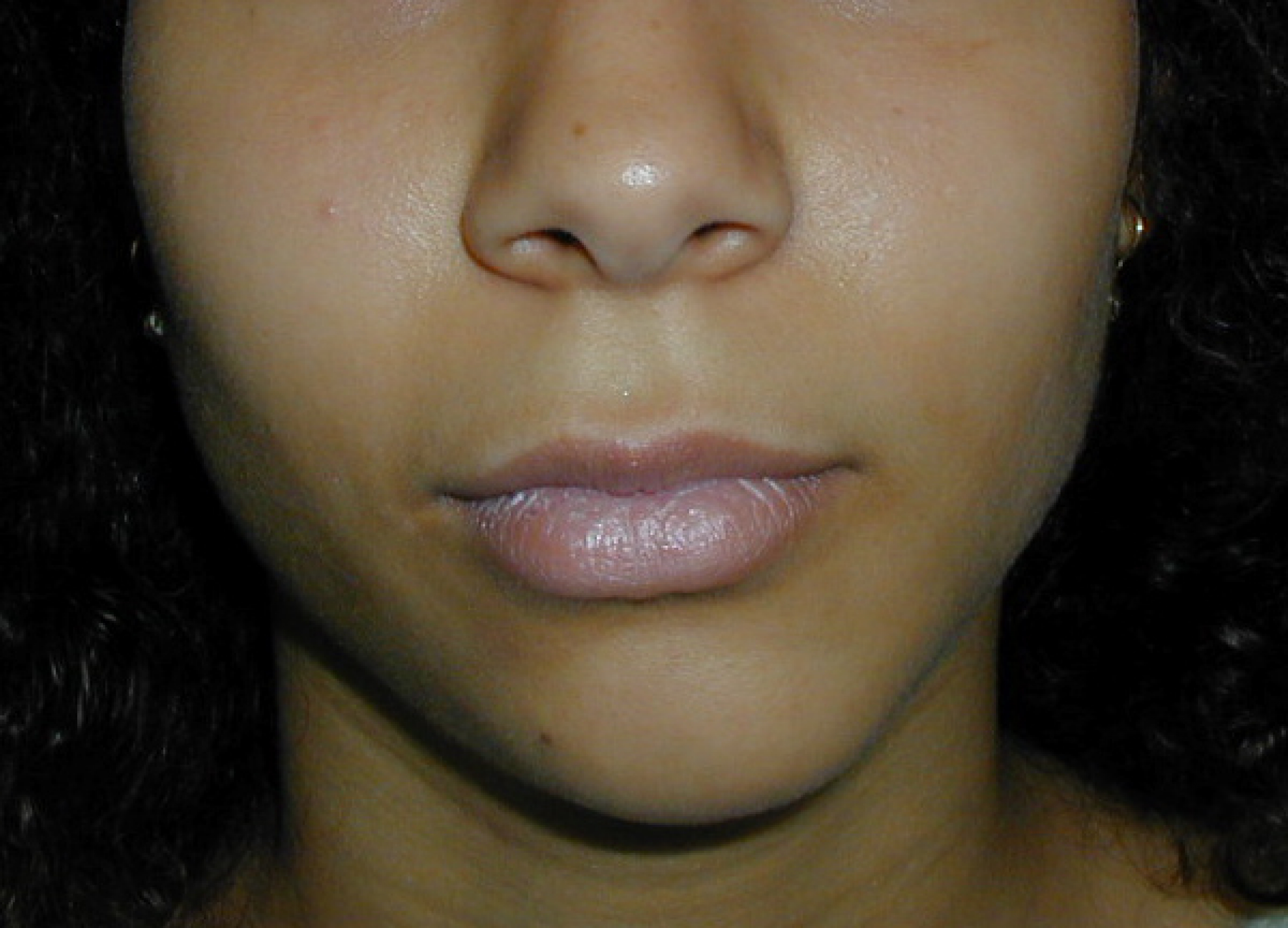 découvrez nos services de correction en chirurgie maxillo-faciale, visant à améliorer la fonction et l'esthétique de votre visage. notre équipe d'experts est dédiée à vous offrir un accompagnement personnalisé et des résultats optimaux pour votre bien-être. prenez rendez-vous dès aujourd'hui pour une consultation.