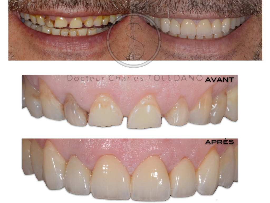 découvrez des conseils et des stratégies efficaces pour prévenir le bruxisme, ce trouble qui entraîne le grincement des dents. apprenez les causes, les symptômes et les méthodes de gestion pour protéger votre santé bucco-dentaire.