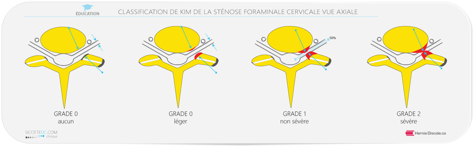 découvrez des conseils pratiques pour adapter votre quotidien face à une hernie foraminale. apprenez à gérer la douleur, à modifier vos activités et à améliorer votre qualité de vie tout en respectant votre condition. informez-vous sur les exercices, les postures et les ajustements nécessaires pour vivre mieux au quotidien.