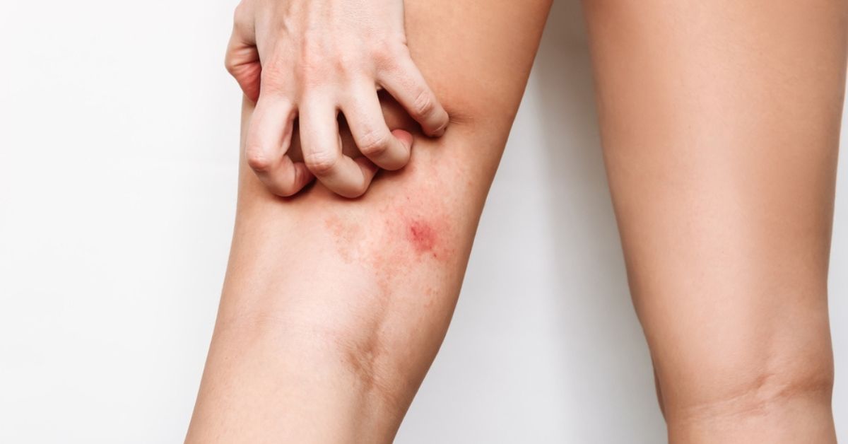 découvrez des astuces pratiques et efficaces pour prévenir les piqûres de moustiques et profiter de l'été en toute tranquillité. apprenez à utiliser des répulsifs naturels et à adopter des gestes simples pour vous protéger et éloigner ces nuisibles. protégez votre peau et passez des nuits paisibles sans démangeaisons.
