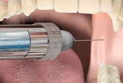 découvrez comment gérer efficacement la douleur lors d'une dévitalisation dentaire grâce à des techniques modernes et des conseils pratiques pour un traitement serein.